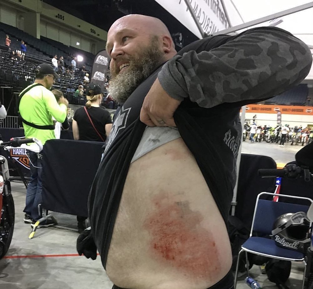 Patrick lifting his jersey to show abrasions on his skin